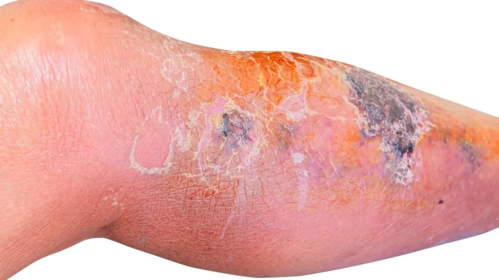 Como Tratar a Celulite Infecciosa e Prevenir a Sepse